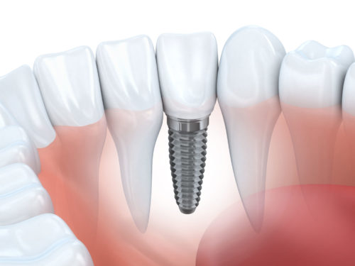 An example of a tooth implant.